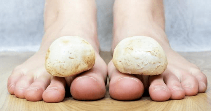 Snelle behandeling van schimmel op de benen thuis