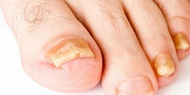 hoe en hoe nagelschimmel te genezen