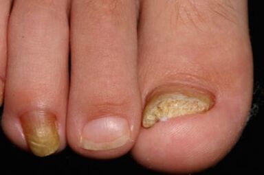 Micose nagels op de benen