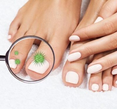 Nagelinfectie door een vergrootglas