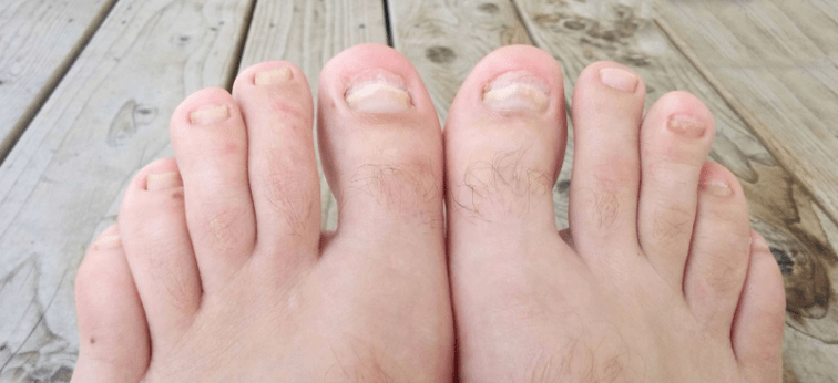 Nagelschimmel