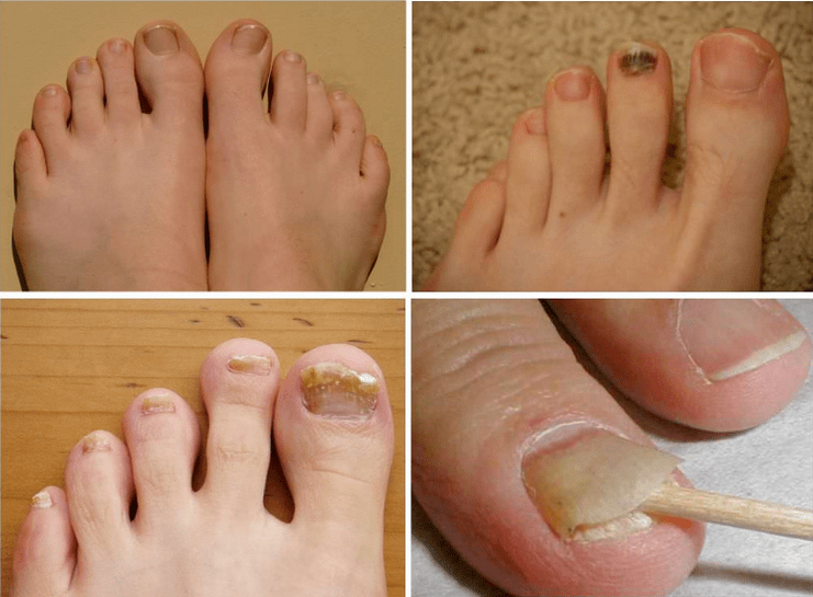 Tekenen van nagelschimmel