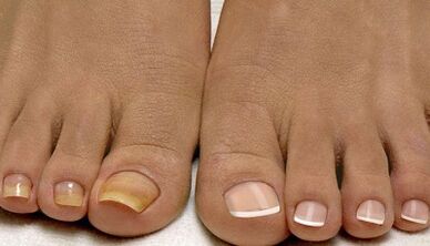 De oorzaken van het uiterlijk van de schimmel op de nagels