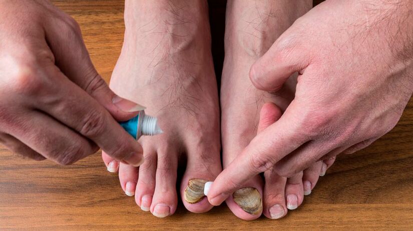 Het aanbrengen van antischimmelcrème op teennagels om onychomycose te behandelen